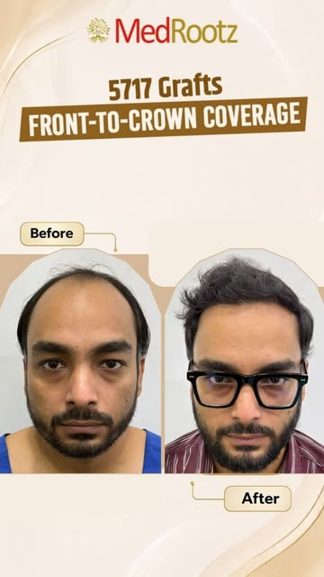 A remarkable 6-month hair transplant transformation for 34-year-old Nitin Singh, who underwent a 571