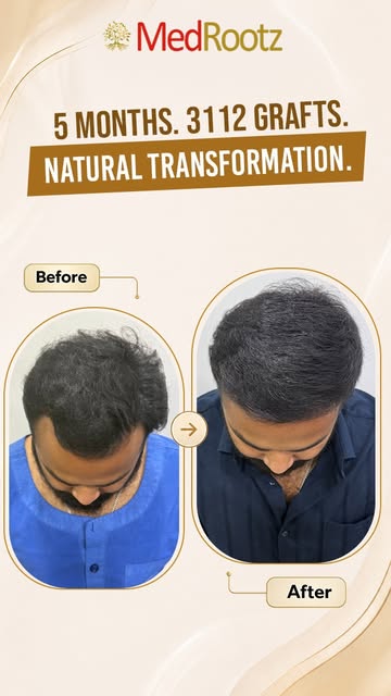At just 27 years old, Kshitij Pandey is showing promising transformation at 5 months after his hair 