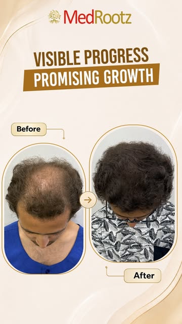 ✨ A Promising Hair Transformation at Just 5 Months & 20 Days!✨

Meet Anirudh Maheshwari, 22 years ol