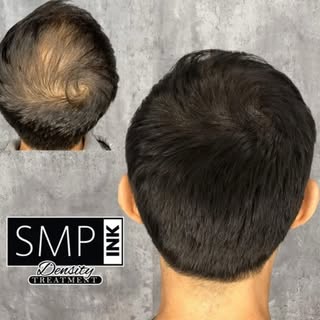 🔘 Restore Your Confidence with SMP Density Fill Services…

Thinning or balding? You’re not alone — 