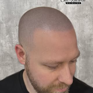 Our client sought a natural hairline to complement his previous hair transplant. Although he had a t