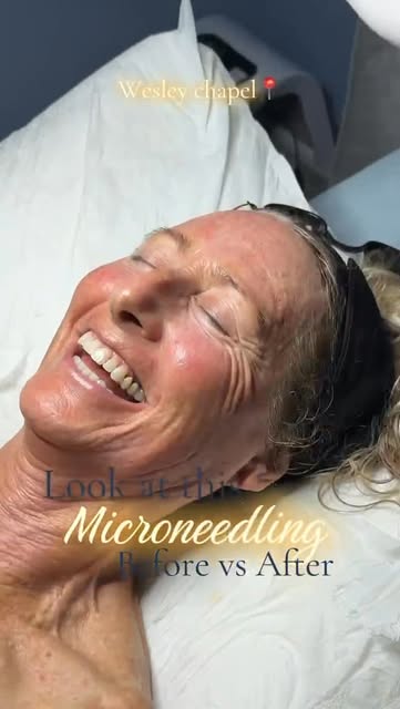 ✨ Microneedling = your skin’s little reset ✨

Stimulate collagen, improve the appearance of fine lin