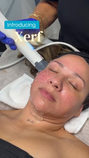 ✨ Meet XERF ✨

Our newest treatment is officially here! XERF uses advanced radiofrequency technology