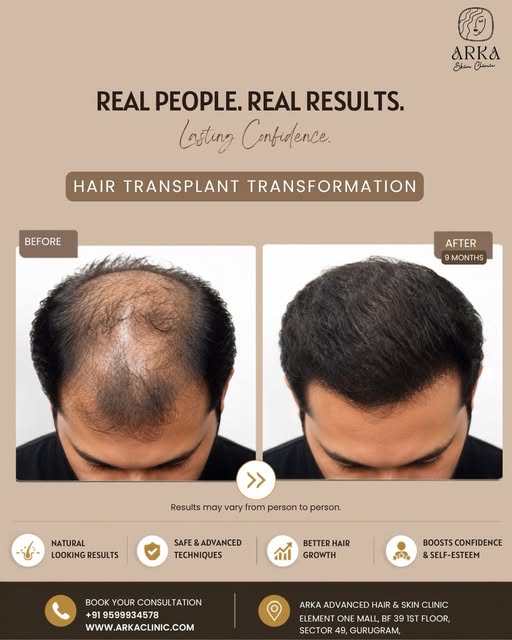Say Goodbye to Hair Loss: 9 Months to Lasting Confidence! 🌿✨

Seeing is believing! Take a look at t