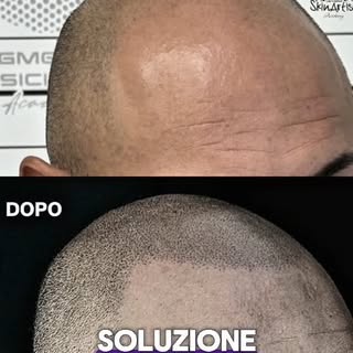 Se stai vivendo calvizie, diradamento, alopecia o hai esiti di cicatrici post trapianto, questo Open