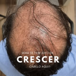 Você sabia que 50% dos homens terão algum grau de calvície antes dos 50 anos? 

Mas não se preocupe,