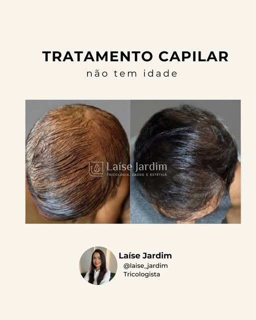 Idade não significam que você precisa se conformar com a perda de cabelos.

Este antes e depois most