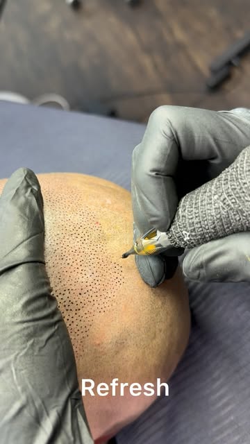 👇🏼

Wenn der Haarausfall bereits in jungen Jahren beginnt und sich zu einer ausgeprägten Alopezie 