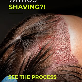 𝐍𝐎𝐍-𝐒𝐇𝐀𝐕𝐄𝐍 𝐅𝐔𝐄 HAIR TRANSPLANT 𝐈𝐌𝐏𝐋𝐀𝐍𝐓𝐄𝐃 𝐖𝐈𝐓𝐇 𝐂𝐇𝐎𝐈 𝐏𝐄𝐍𝐒 ✍️

@doctor