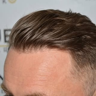 Pictures are taken 2 year post surgery. I combed it open in all possible ways to show the density. 

