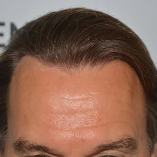 This man's life has drastically changed. 

Patient has had three FUE treatments. Result of the 3rd w