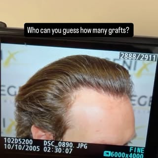 4 years after hair transplant without Finasteride/Minoxidil.