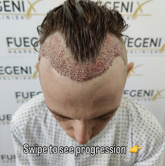 @fuegenixhairclinic is a master! An artist! Every graft is harvested and placed with naturalness and