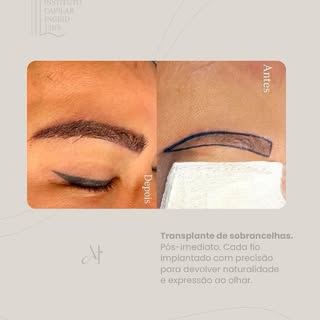 Pós-operatório imediato após transplante de sobrancelhas. Resultado natural, fios reposicionados com