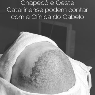 Se você vive em Chapecó ou no Oeste Catarinense, e deseja fazer um transplante capilar, veja esse ví