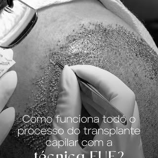 Muitas pessoas chegam à nossa clínica acreditando que o transplante é um evento de um único dia.

Na