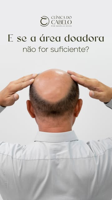 E se eu não tiver cabelo suficiente na cabeça para fazer o transplante capilar? Posso utilizar fios 
