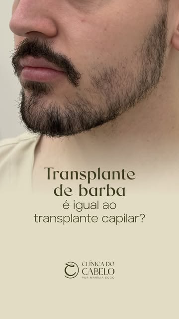 Transplante de barba e transplante capilar têm a mesma base: a técnica FUE. Mas isso não significa q