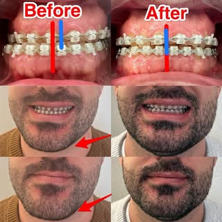 Orthognathic surgery : Recentering and setback mandibular osteotomy. The patient had a deviation of 