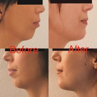 Orthognathic surgery 💀🪄🎯: mandibular advancement + chin advancement (genioplasty) fixed by a pref