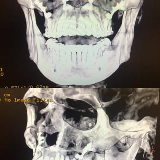 Orthognathic surgery : maxillary advancement to increase volume and definition of the midface, + cor