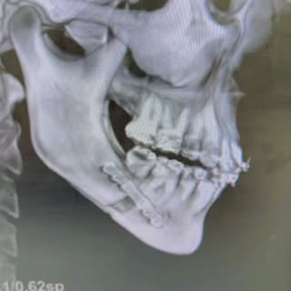 Mandibular advancement : look at this gap, 1cm advancement 💀🪄#orthognathicsurgery #maxillofacialsu