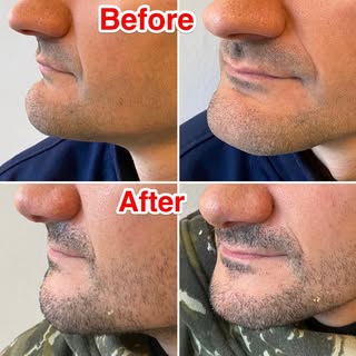 Remodeling genioplasty : complete excision of the chin protuberance to decrease volume. The profile 