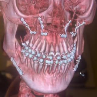 Orthognathic surgery : bimaxillary osteotomy 💀🎯🪄#maxillofacial_surgery #orthognathicsurgery #face