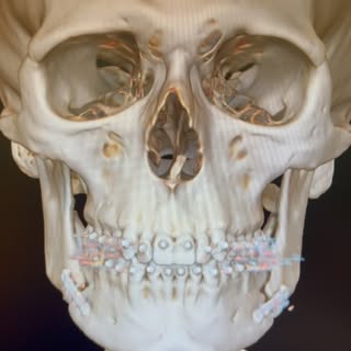 Orthognatic surgery : mandibular advancement 💀🪄🎯💎 Look at the quality of the scan 3D reconstruct