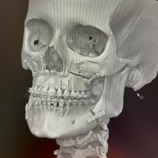 Orthognathic surgery 💀🎯: bimaxillary osteotomy with leveling of the occlusal plan #maxillofacial_s