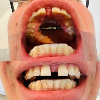 SARPE = Surgically Assisted Rapid Palatal Expansion  When you need some space, just create it ! 🪄💀