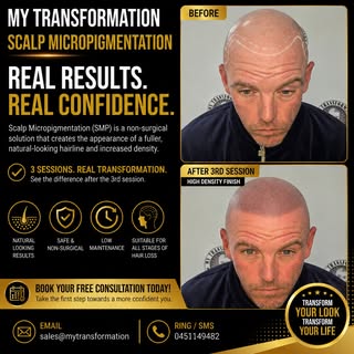 Hairline Restoration with Scalp Micropigmentation 🌟 Scalp micropigmentation/ SMP
Redness will disap