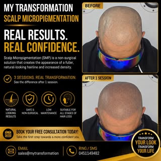 Hairline Restoration with Scalp Micropigmentation 🌟 Scalp micropigmentation/ SMP
Redness will disap