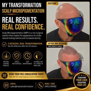 Hairline Restoration with Scalp Micropigmentation 🌟 Scalp micropigmentation/ SMP
Redness will disap