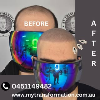 Hairline Restoration with Scalp Micropigmentation 🌟 Scalp micropigmentation/ SMP
Redness will disap