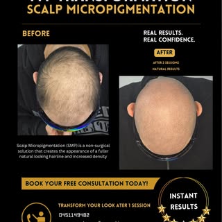 Hairline Restoration with Scalp Micropigmentation 🌟 Scalp micropigmentation/ SMP
Redness will disap