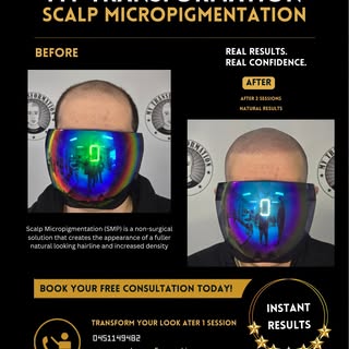 Hairline Restoration with Scalp Micropigmentation 🌟 Scalp micropigmentation/ SMP
Redness will disap