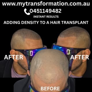 Hairline Restoration with Scalp Micropigmentation 🌟 Scalp micropigmentation/ SMP
Redness will disap