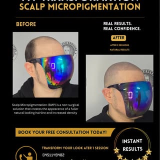 Hairline Restoration with Scalp Micropigmentation 🌟 Scalp micropigmentation/ SMP
Redness will disap