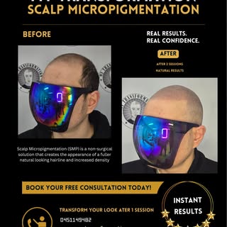 Hairline Restoration with Scalp Micropigmentation 🌟 Scalp micropigmentation/ SMP
Redness will disap