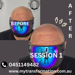 Hairline Restoration with Scalp Micropigmentation 🌟 Scalp micropigmentation/ SMP
Redness will disap