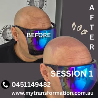 Hairline Restoration with Scalp Micropigmentation 🌟 Scalp micropigmentation/ SMP
Redness will disap