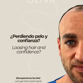 Resultados reales que hablan por sí solos

Este antes y después de un trasplante capilar refleja un 