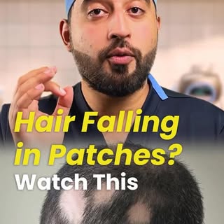 Alopecia areata explained 👇

This is an autoimmune form of hair loss.
It happens when your immune s