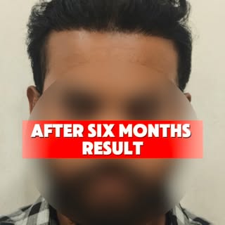 ✨ From Hair Loss to Hair Confidence! ✨

This patient came to us with advanced hair loss after consul