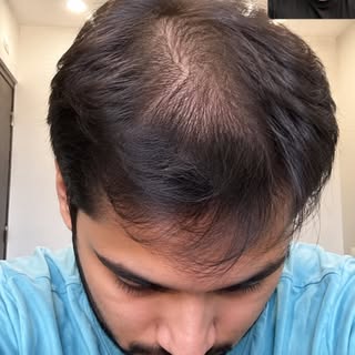 Hair thinning, visible scalp, or a receding hairline affecting your confidence?

You don’t have to i