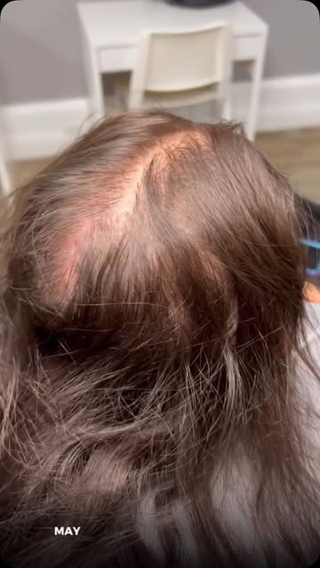 Can’t stop working out, but noticing hair fall or a receding hairline?

Heavy workouts, genetics and