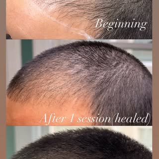 This is the power of SMP 💪 

FRAMED offers affordable scalp micro pigmentation services to the San 