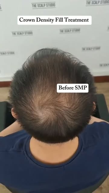 Say goodbye to visible crown scalp show-through under light!

Crown thinning and diffuse scalp show-