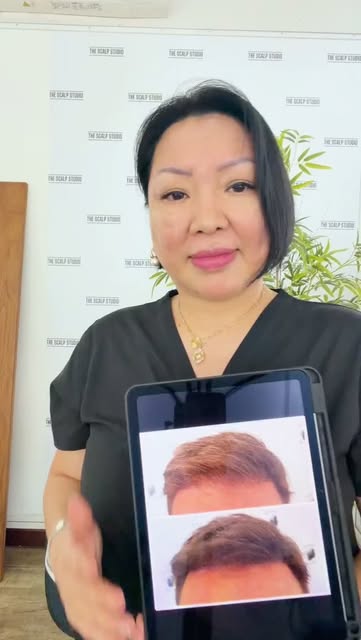 How long does Scalp Micropigmentation actually last? 💡

"How long would my SMP last?" This is one o